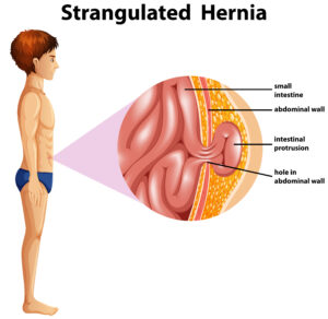 Causes of Hernia