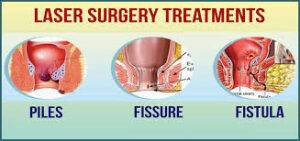 Difference between Piles, Fissures, and Fistula
