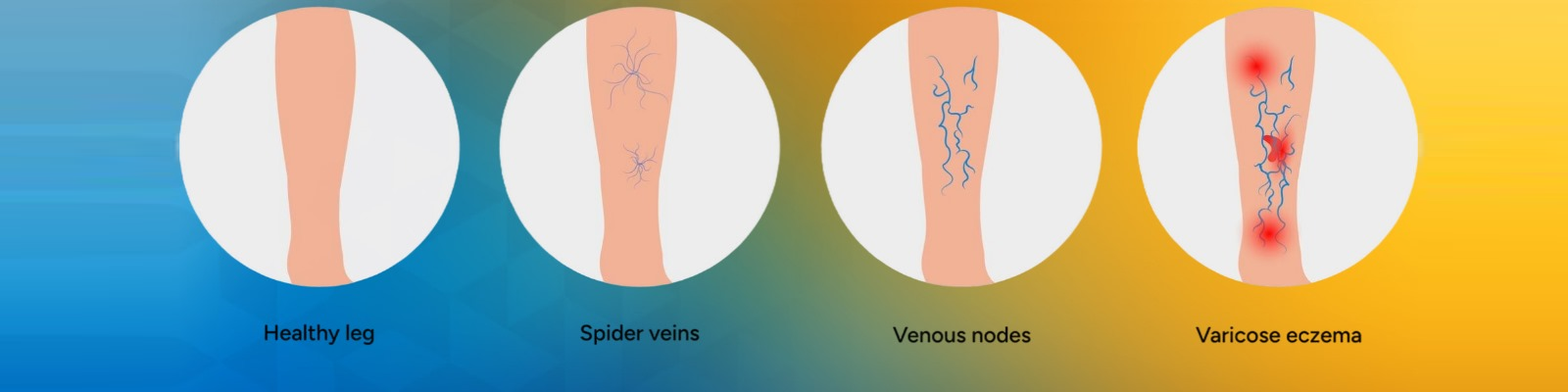 Varicose Veins